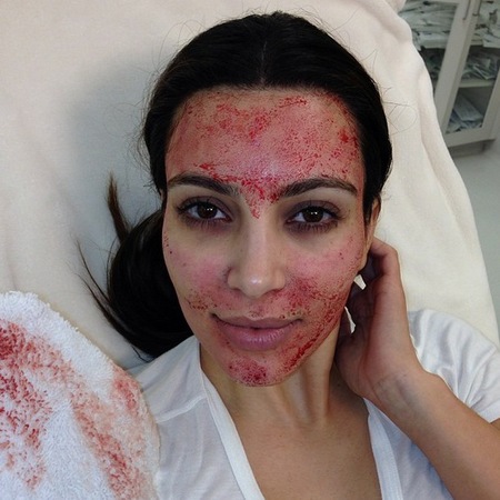kim_kardashian_blood_face_vampire_facial_facelift
